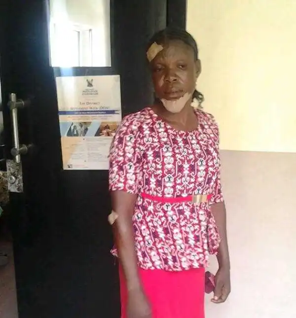 Woman Breaks Her Neighbour’s Jaw With Shovel Over Fruit In Lagos (Photo)